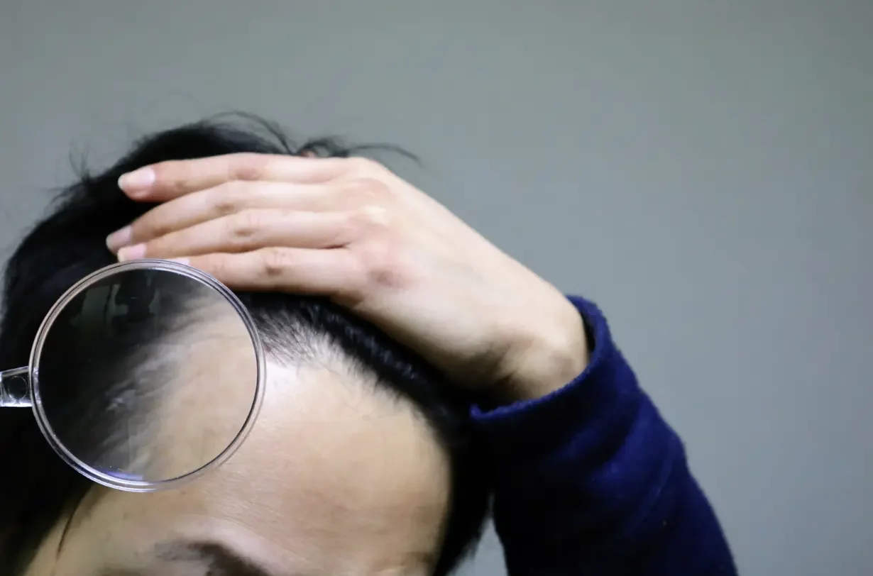 AGAの遺伝メカニズム（母方X染色体・両親常染色体）のイメージ
