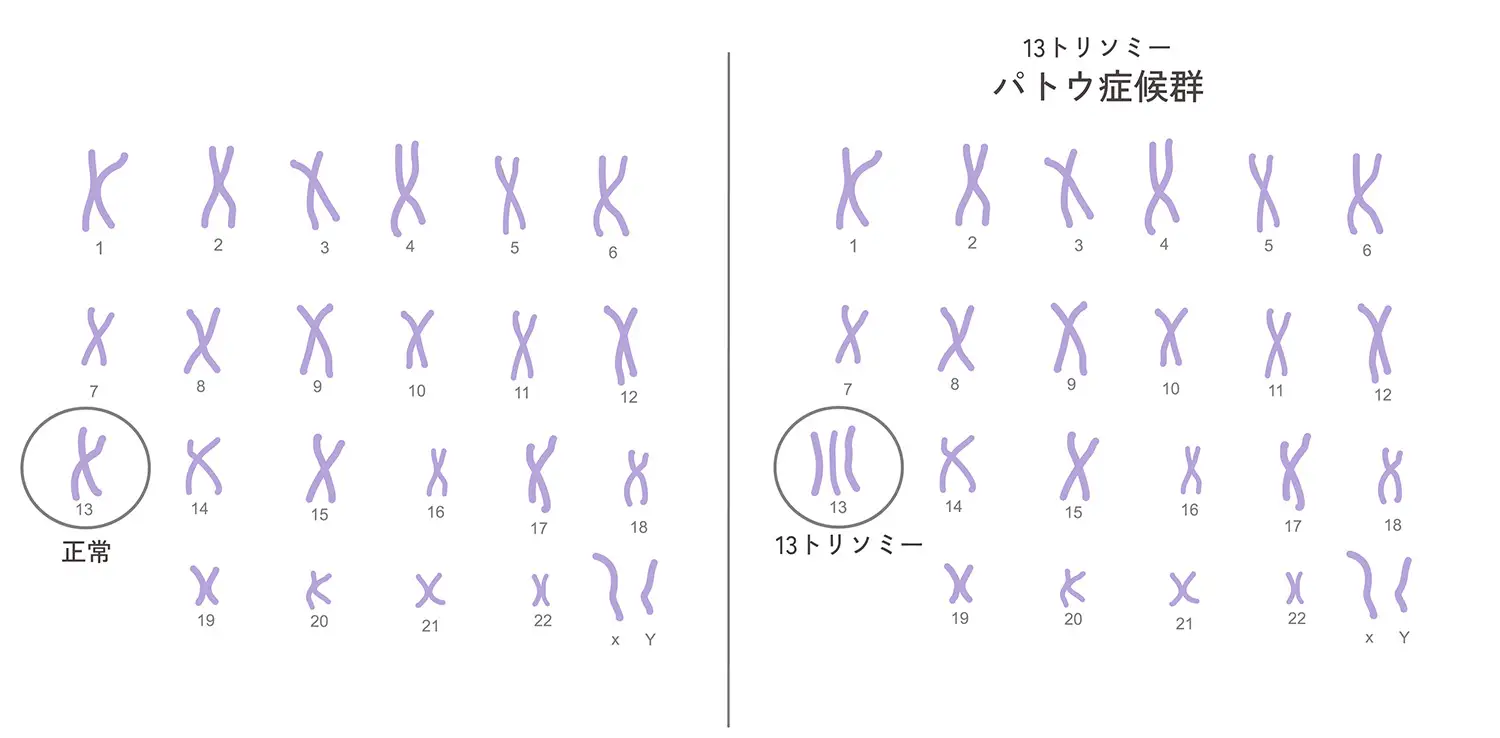 13trisomy