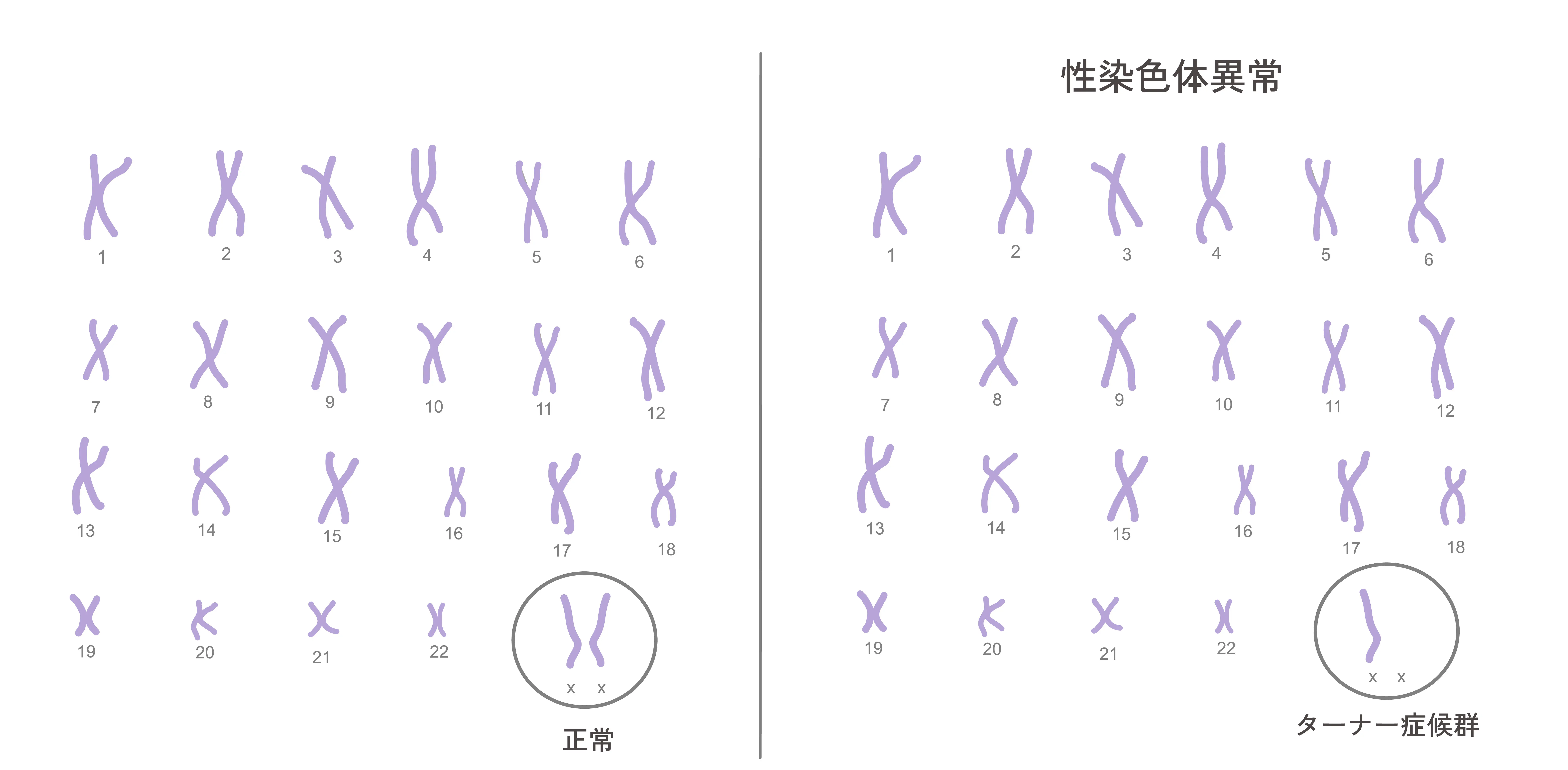 Turner Syndrome Karyotype