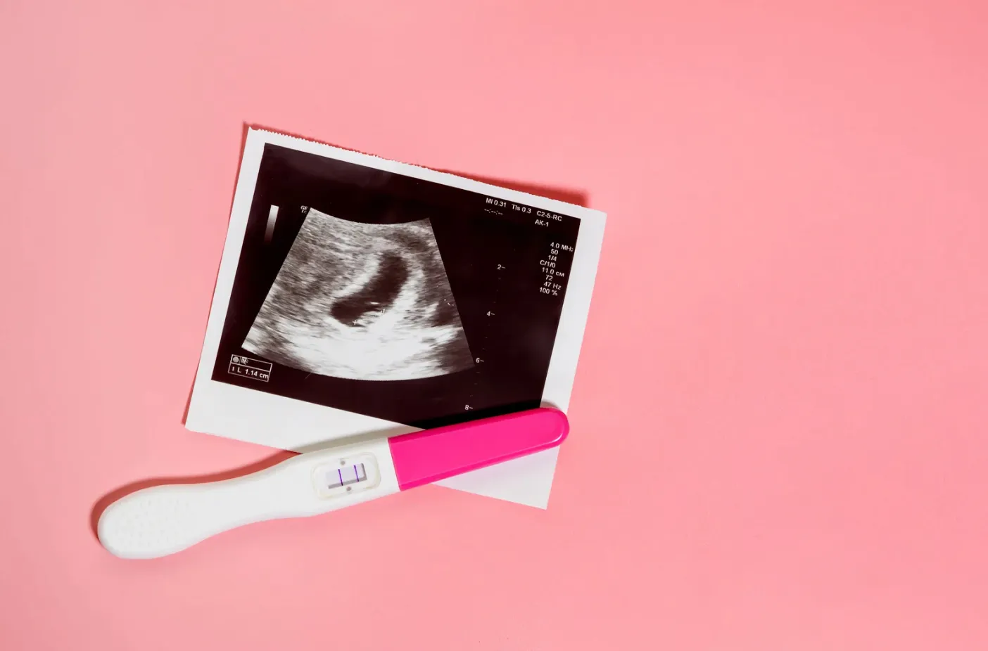 Precautions and Benefits of NIPT After Artificial Insemination